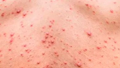 Photo of OMS alerta sobre el virus de la Viruela del Mono detectado recientemente