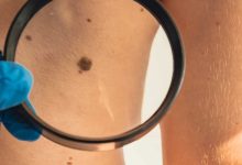 Photo of Cuba desarrolla tratamiento para el cáncer de piel, en medio de la crisis de medicamentos